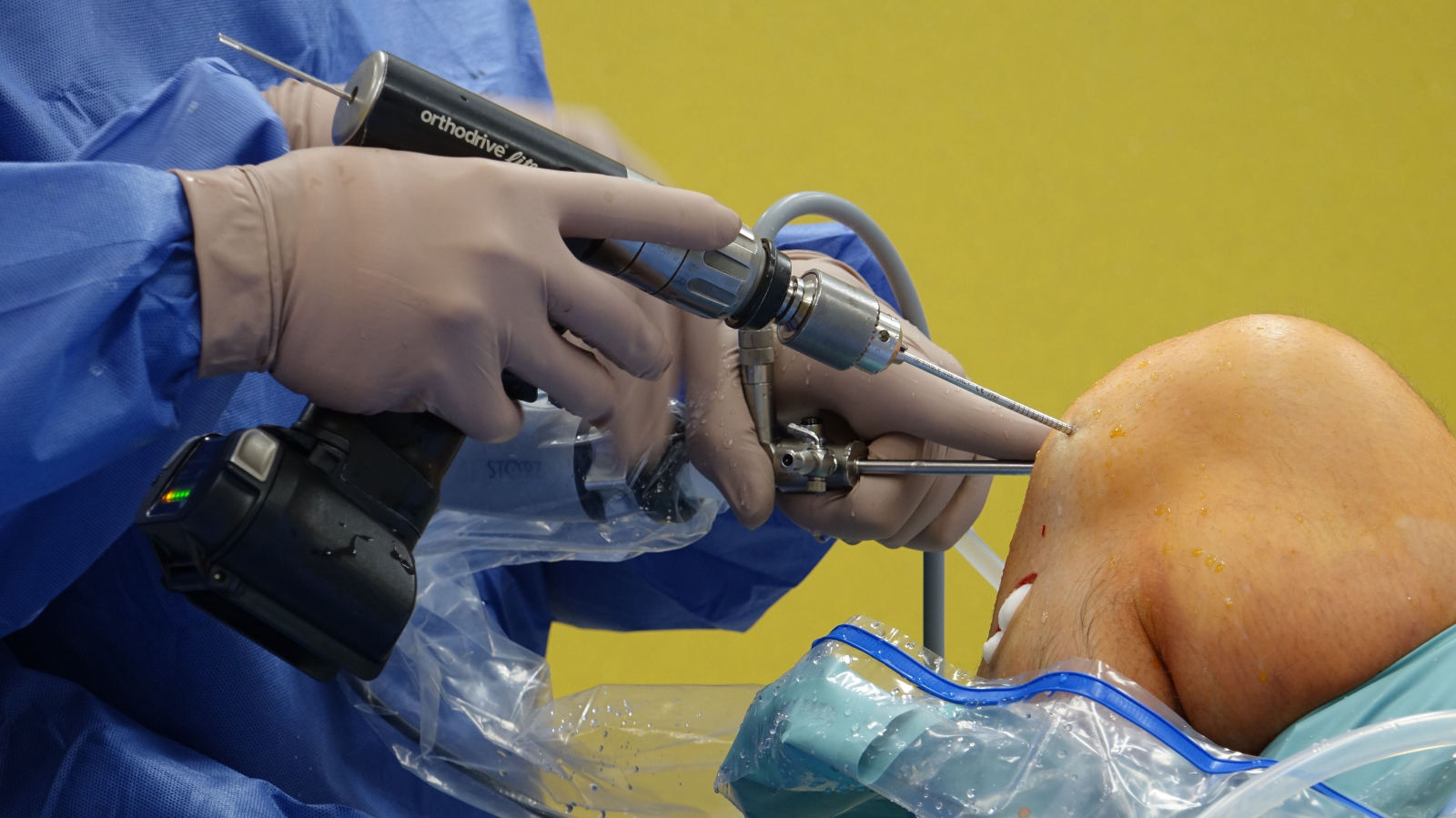 Arthroscopy surgery at Purva Hospital