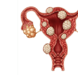Illustration of a uterus with several fibroids