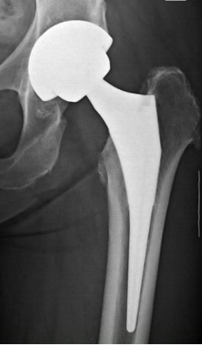 X-ray of a total hip replacement showing the metal cup in the pelvis and the ball and stem in the thigh bone